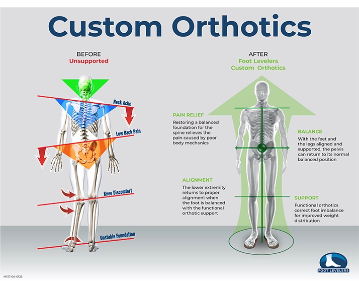 Chiropractic Waukee IA Orthotics Custom Orthotics graphic showing the before and after the use of Foot Levelers.